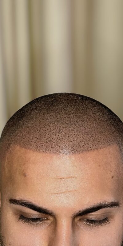 SMP (Scalp Micropigmentation) (12)