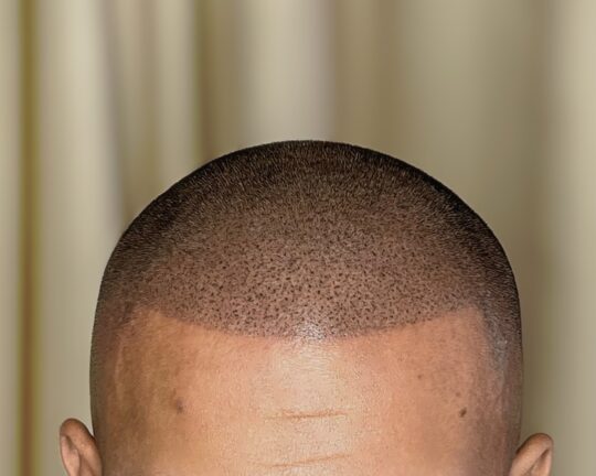 SMP (Scalp Micropigmentation) (12)